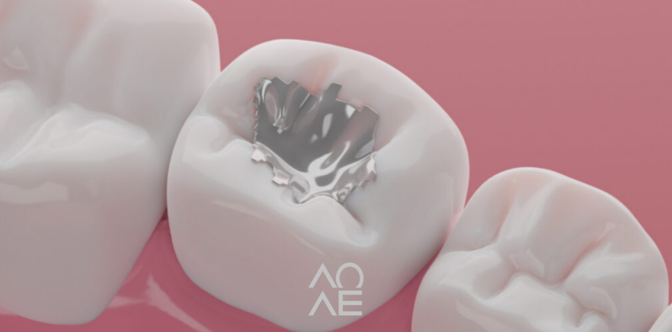 강남양심치과에서 오래된 아말감 교체하세요! 관련 이미지 2