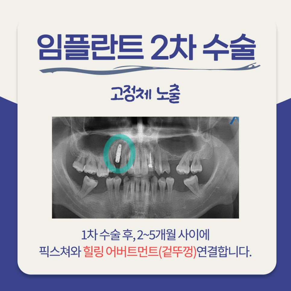 임플란트 시술과정 총 몇번 치과에 가야할까? 관련 이미지 4