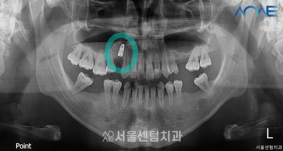 Here’s How a Korean-Made Implant Is Actually Placed image 3