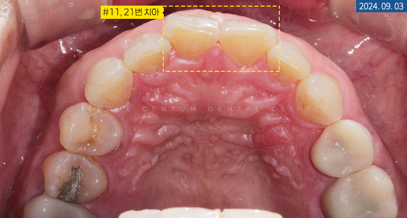 라미네이트전후 치아의 가지런한 정도와 밝기 차이 확인하기 관련 이미지 5