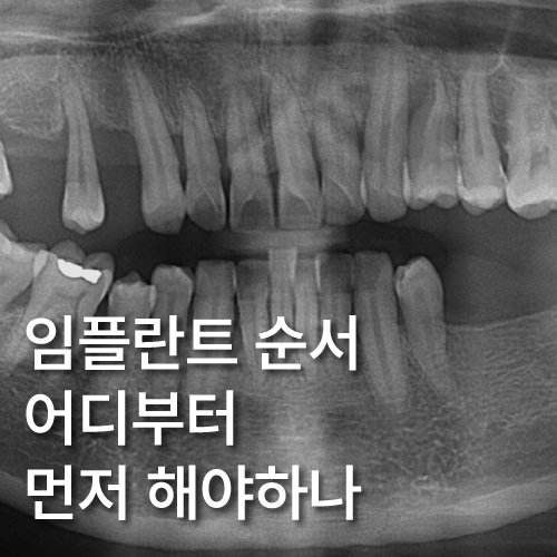 임플란트 순서 어금니부터 앞니부터 어디부터 해야할까요 관련 이미지 1