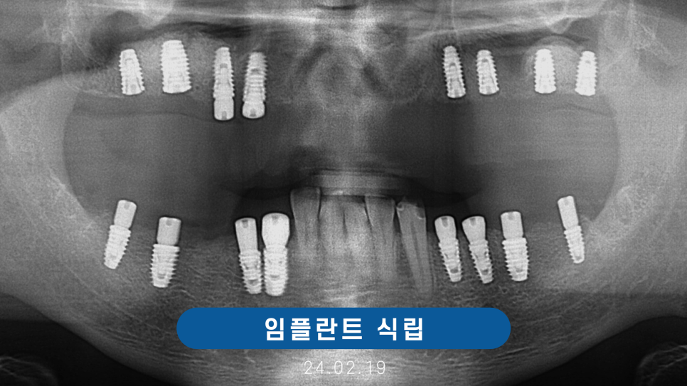 전체임플란트 노인틀니 보험 실비 비용 관련 이미지 7
