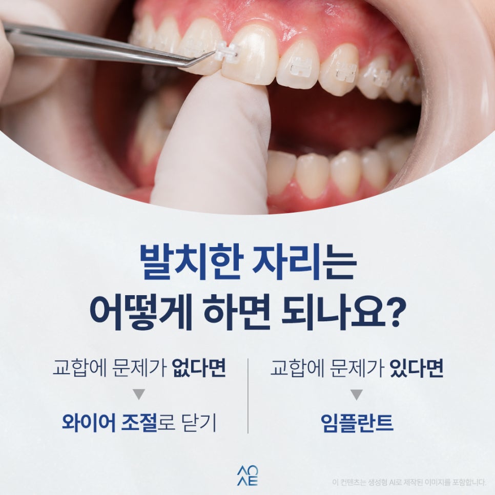 Do I Need Full Orthodontic Treatment After Extracting a Crowded Tooth? image 5