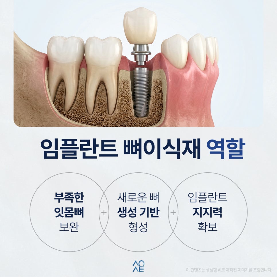 임플란트 뼈이식 재료 완전히 제거하고 싶은데 가능한가요? 관련 이미지 2