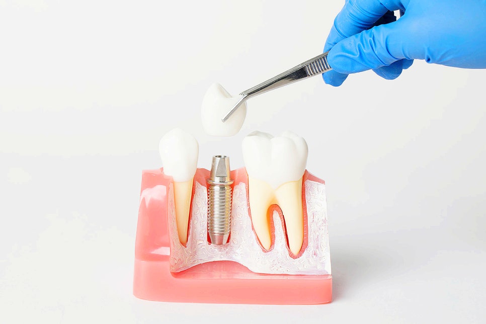 잠원동임플란트 2차수술 과정 기간 순서 시간 관련 이미지 5