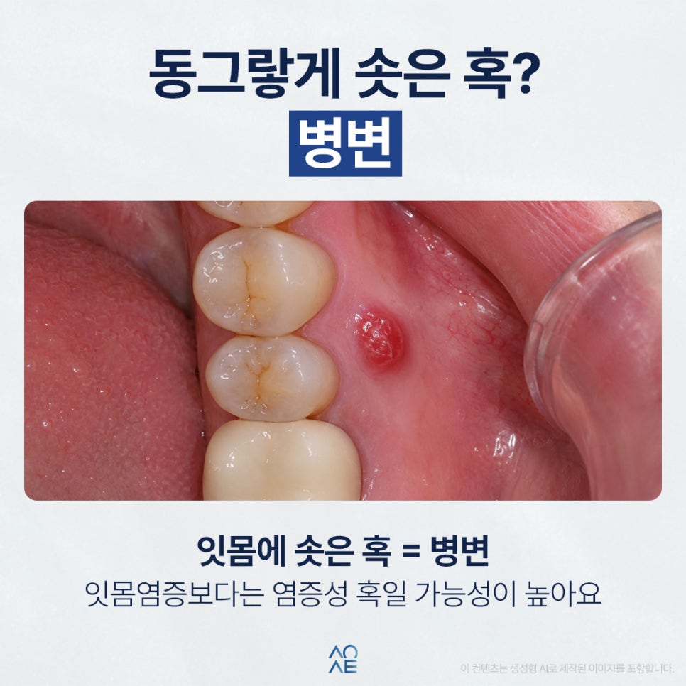 Could the Lump on My Gums Be Related to the Molar Crown? image 2