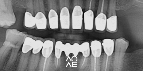 잠원동 교정 반대교합 크라운 치료도 가능합니다. 관련 이미지 11