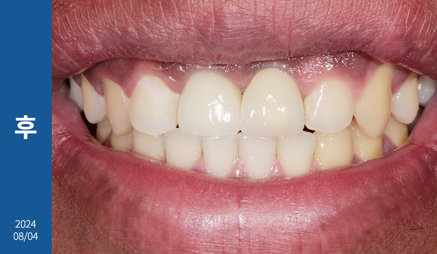 앞니 임플란트 식립으로 저작 기능을 끌어올린 증례 관련 이미지 19