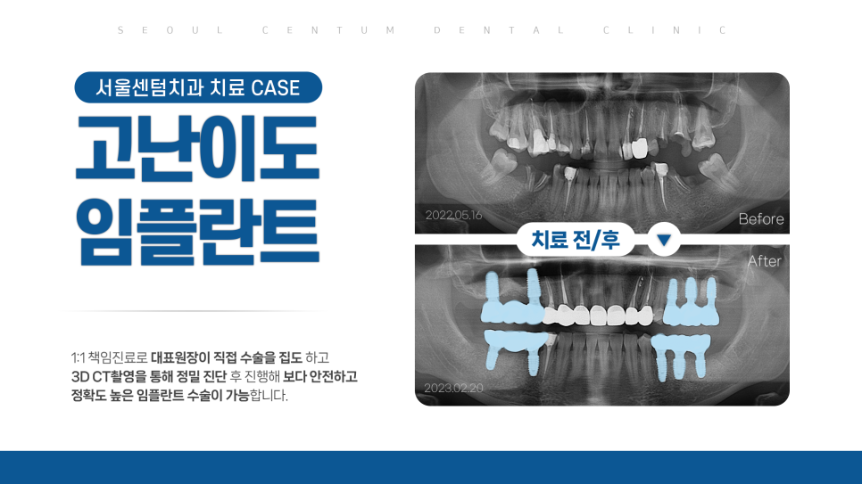 국민 건강보험 임플란트 노인 무치악의 기준은? 관련 이미지 3