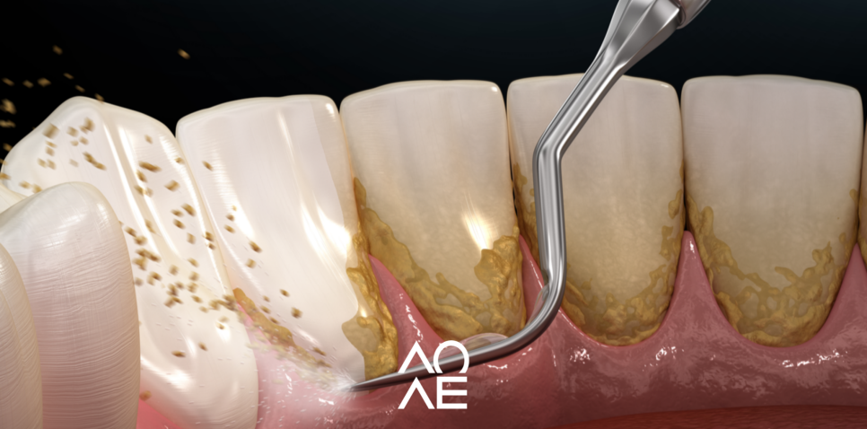 잠원동 스케일링 후 통증 당연히 있을 수 있습니다. 관련 이미지 5