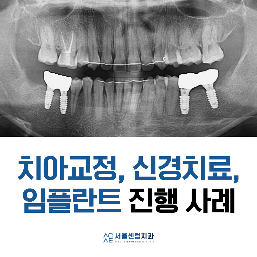 돌출입 및 신경치료와 임플란트 식립 동시 진행 증례 관련 이미지 1