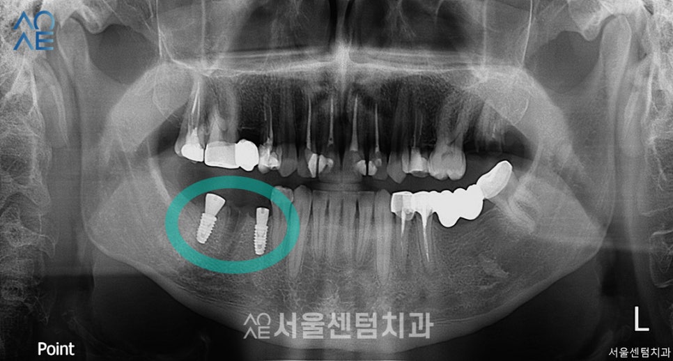 20대임플란트 처음이라 두렵다면 관련 이미지 2