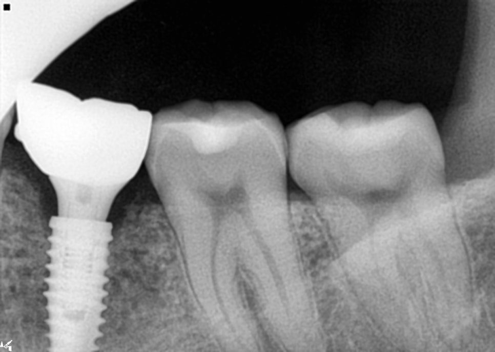40대 임플란트 치료 케이스 상악동거상술 골이식까지 관련 이미지 13