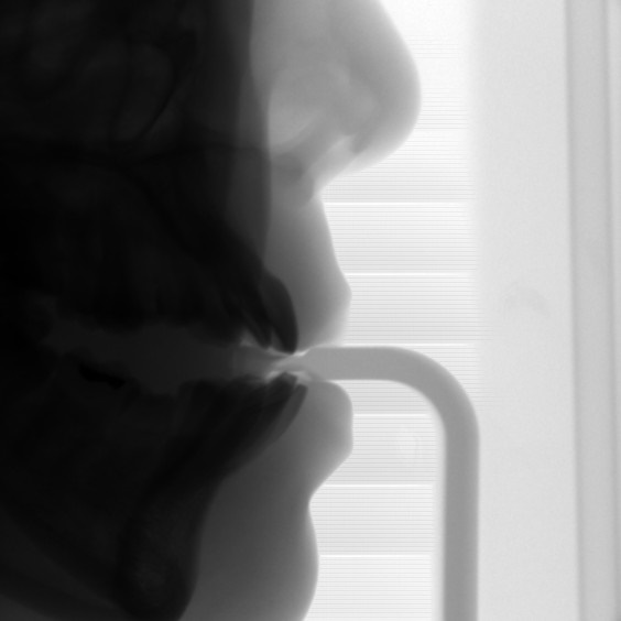 임플란트 순서 어금니부터 앞니부터 어디부터 해야할까요 관련 이미지 2