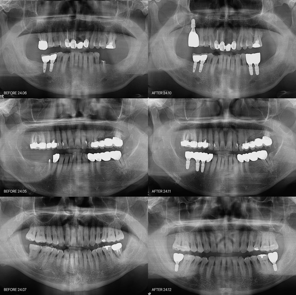 임산부임플란트 출산후에 임플란트해야할까요? 관련 이미지 6