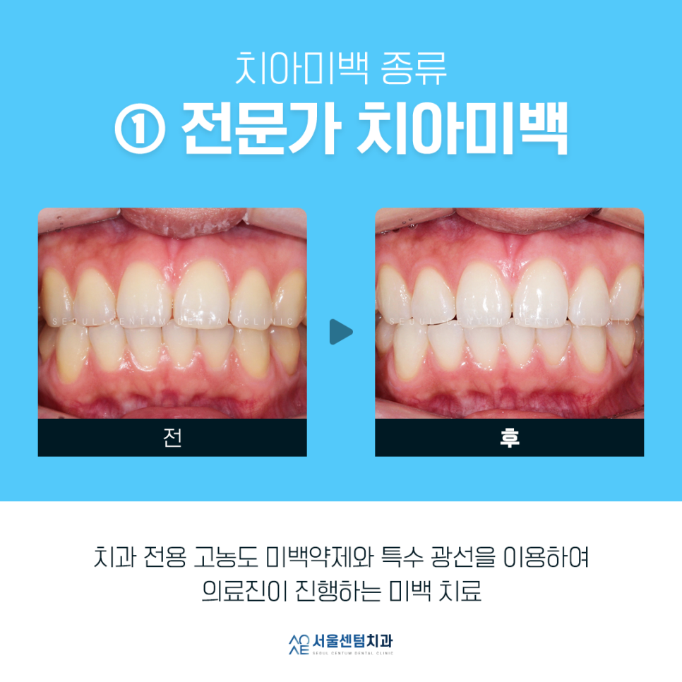 치과치아미백 전후 사진과 종류 소개 관련 이미지 1