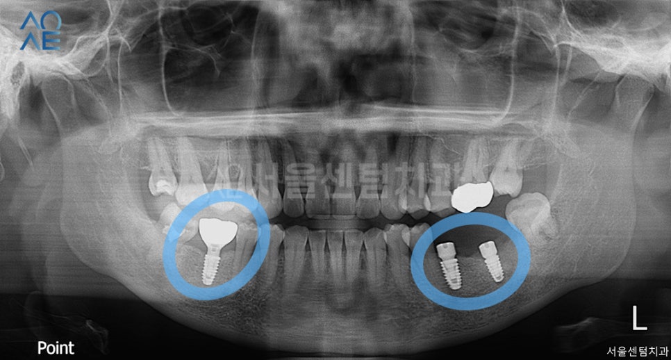 치아상실 후 임플란트 하려면 관련 이미지 3