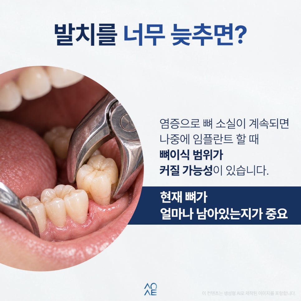 임플란트 발치 언제가 좋을까요 뼈가 녹고 있다면 빨리해야 돼요? 관련 이미지 4