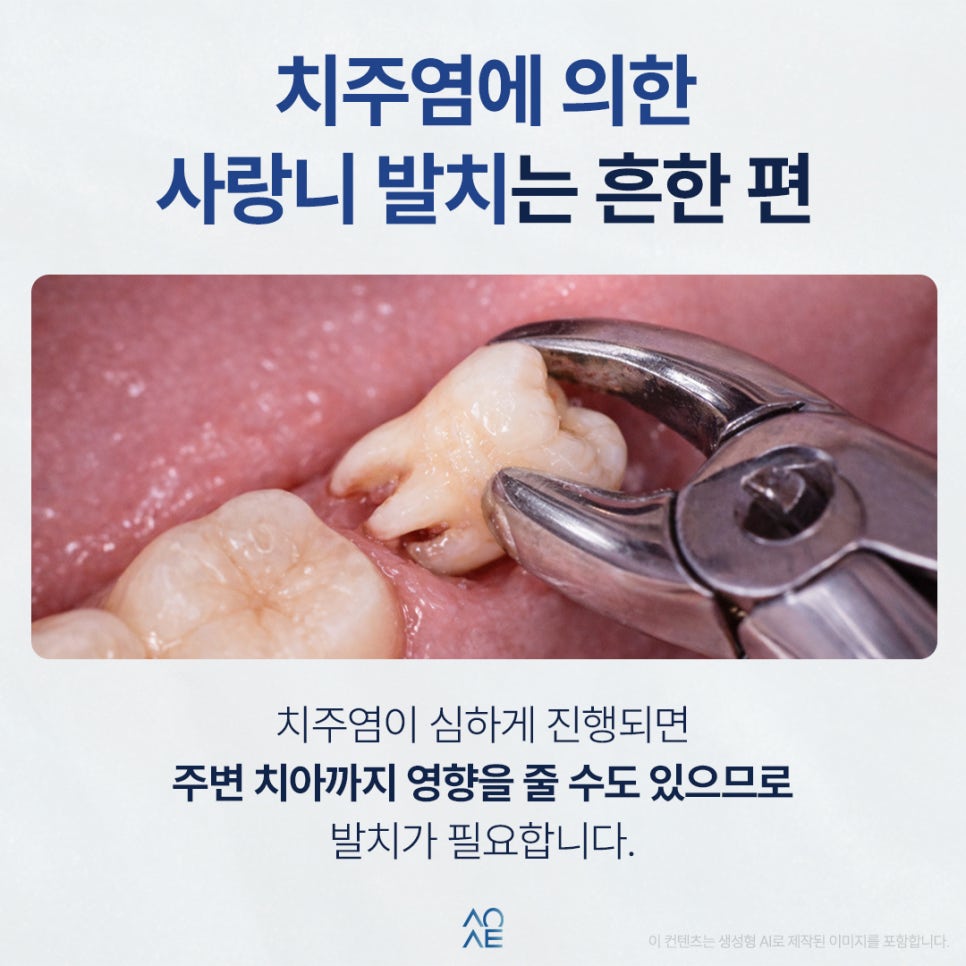 임플란트 치주염 옆자리에 권유받았다면 필요한지 판단할 것 관련 이미지 2