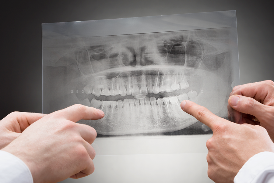 신사동치과 임플란트 끝난 후 절대 잊지 말아야 할 주의사항 관련 이미지 9