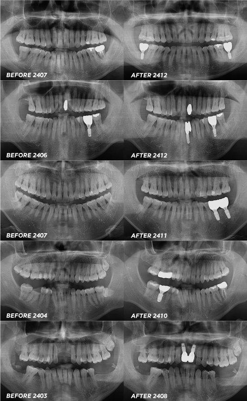 20대 임플란트 비용 후기 수명 문의 후회 없는 선택을 위해 정리해드려요 관련 이미지 6