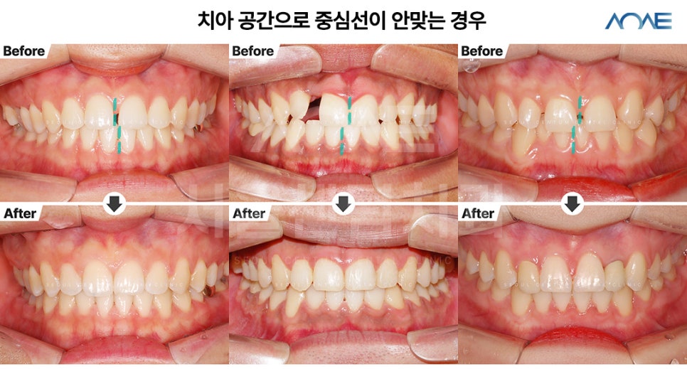 치아중심선교정 다양한 실제사례 보여드려요 관련 이미지 3