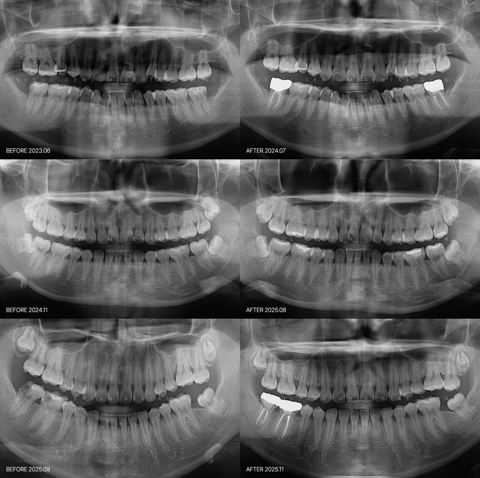 충치 초기 미세한 변화 증상이 점차 불어날 수 있는 시기 관련 이미지 6