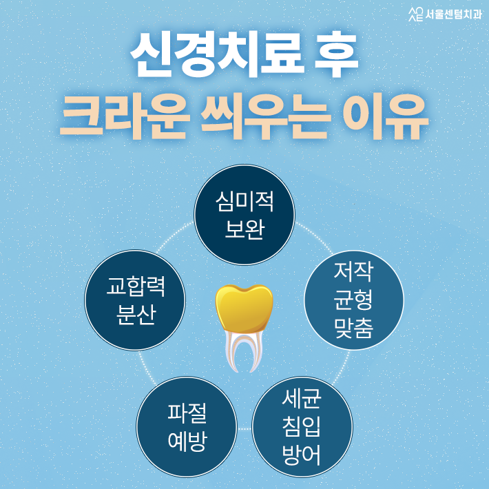 신경치료 시 크라운 수명이 달라지는 원인은 종류 때문일까 관련 이미지 2