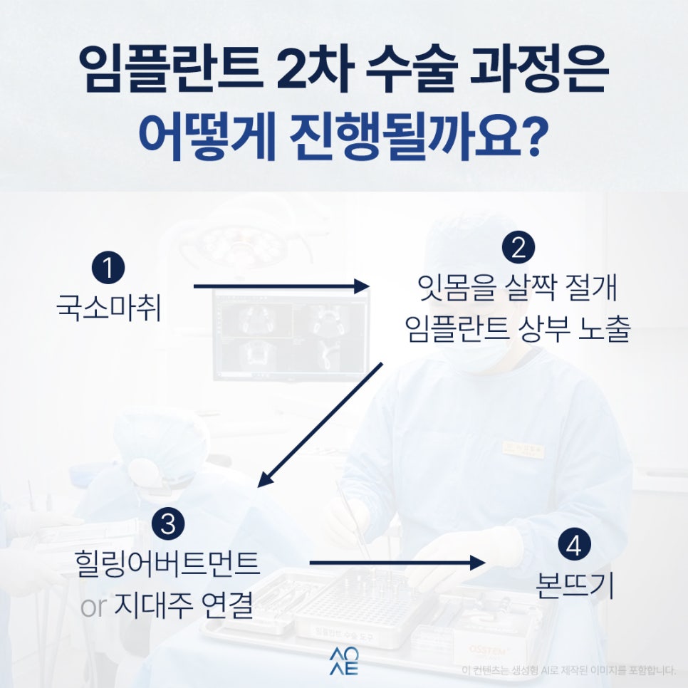 임플란트 2차 수술 후기 생각보다 안 아팠다는 말이 많은 이유 관련 이미지 4
