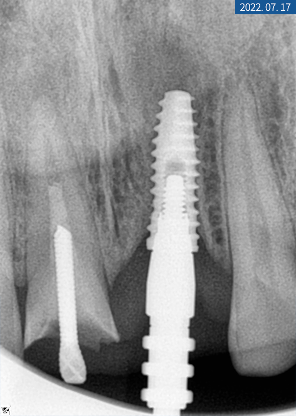 앞니 임플란트 식립으로 저작 기능을 끌어올린 증례 관련 이미지 6