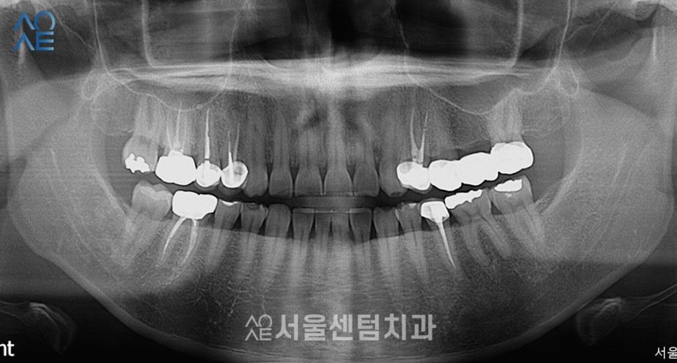 라미네이트 앞니 깨짐과 마모 해소한 증례 살펴보기 관련 이미지 2