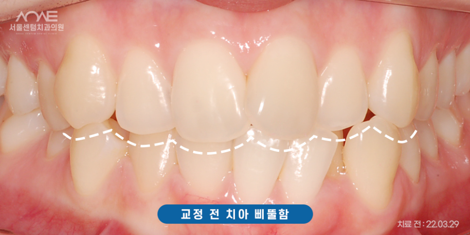 총생 앞니 덧니 발치 후 치아교정? 관련 이미지 3