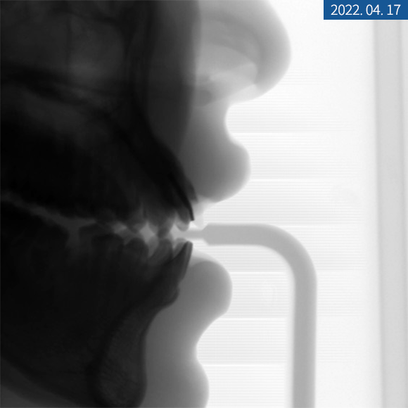 앞니 임플란트 식립으로 저작 기능을 끌어올린 증례 관련 이미지 4