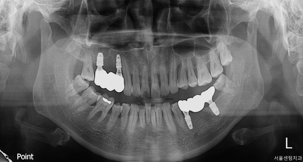 임플란트 순서 어금니부터 앞니부터 어디부터 해야할까요 관련 이미지 6