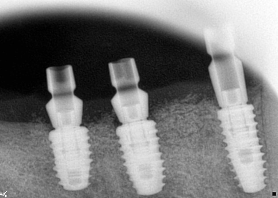 40대임플란트 수술 어떻게 하나요? 관련 이미지 3