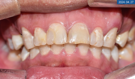 뼈이식 임플란트와 라미네이트 수복 증례 소개 관련 이미지 6