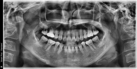 신사역 매복 사랑니 4개 발치 꼭 해야하나요? 관련 이미지 10