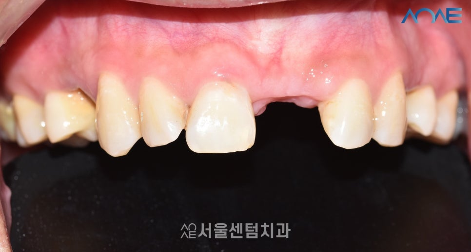 당일임플란트 상담부터 풀과정 공개 관련 이미지 5