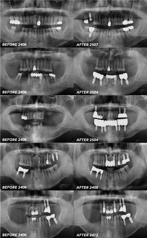 임플란트보증기간 간발의 차이로 치료비 더 내지 마세요 관련 이미지 6