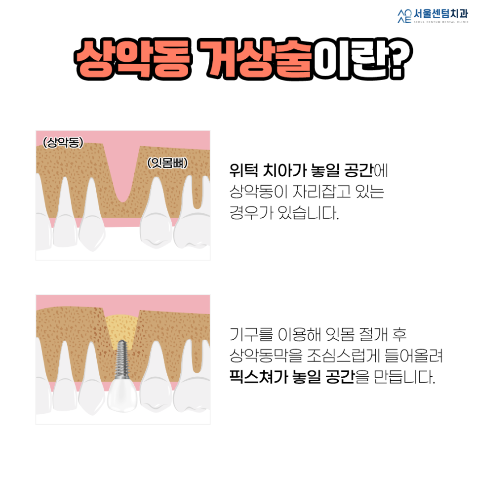 상악동거상술 주의사항 반드시 체크해야할 것 관련 이미지 2