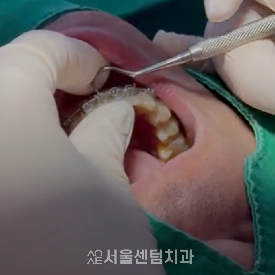 Read This Before Starting Protruding Teeth Correction image 5