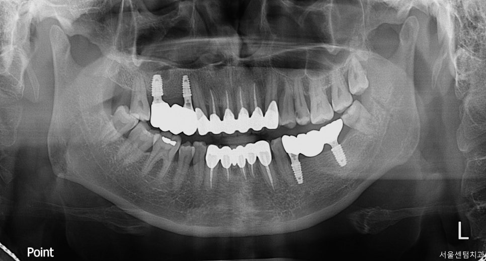 임플란트 순서 어금니부터 앞니부터 어디부터 해야할까요 관련 이미지 11