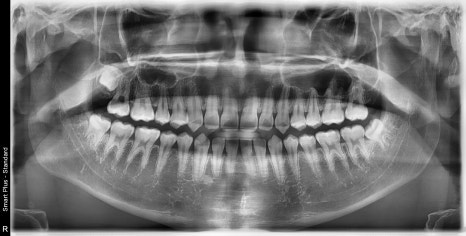 신사역 매복 사랑니 4개 발치 꼭 해야하나요? 관련 이미지 11