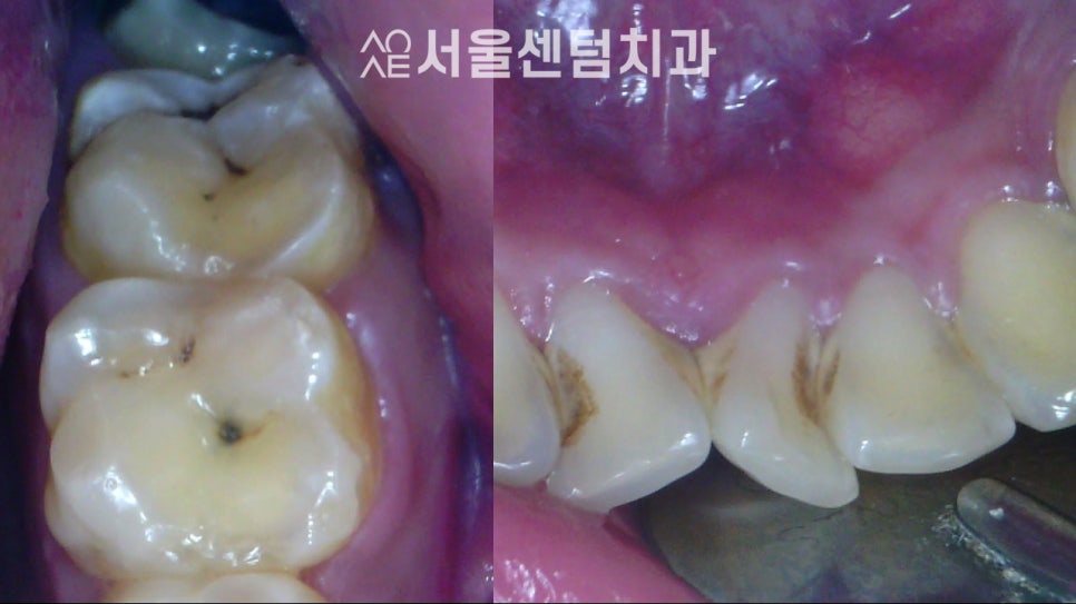 A Successful Molar Implant Case in a Patient in Their 20s image 3