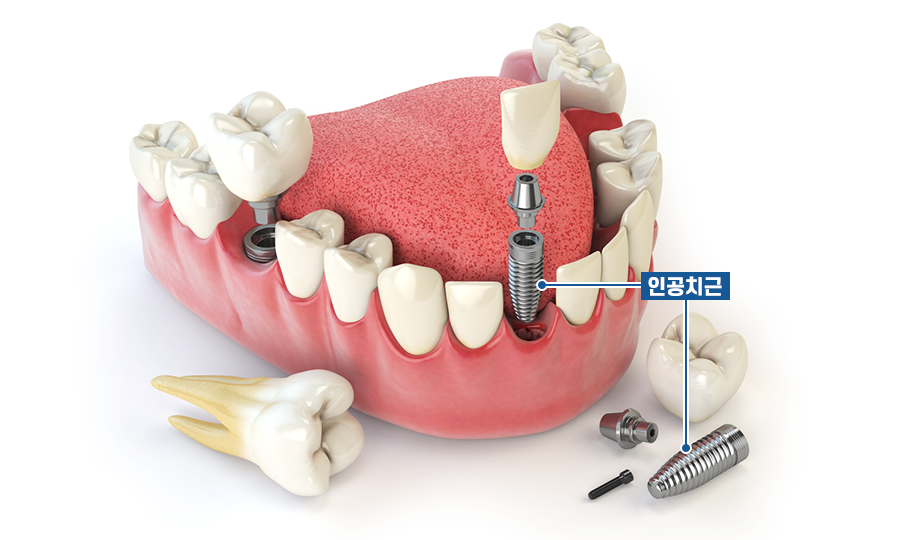 상악 전체임플란트 혹시 나도 대상자일까? 관련 이미지 5