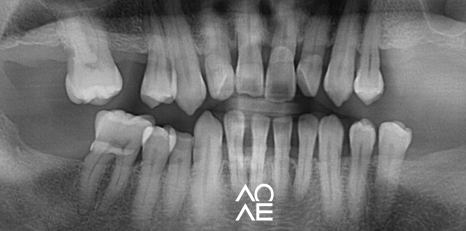 잠원동 교정 반대교합 크라운 치료도 가능합니다. 관련 이미지 3