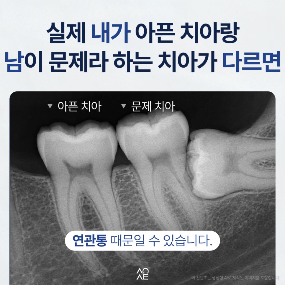 Can Pain Be Felt in Front of a Cracked Molar? A Different Tooth Is Hurting image 3