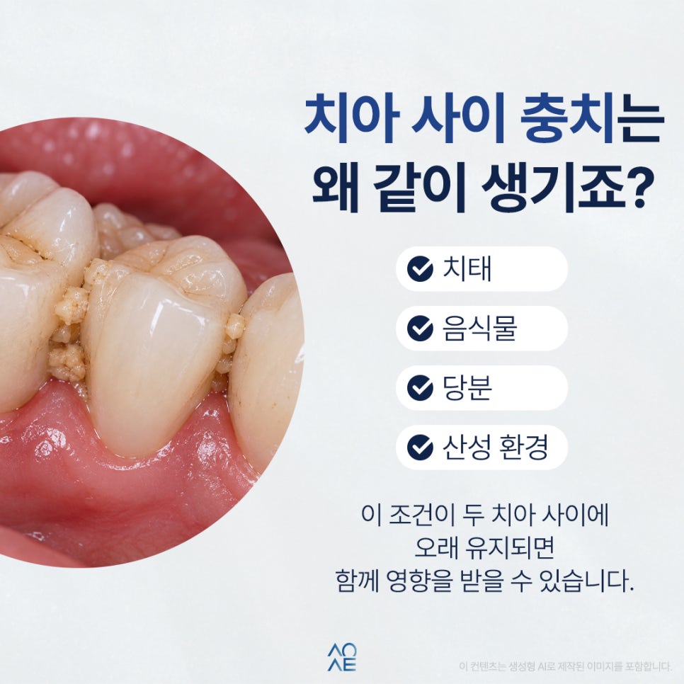 치아 사이 충치 옆까지 옮겨질 수 있나요? 관련 이미지 2