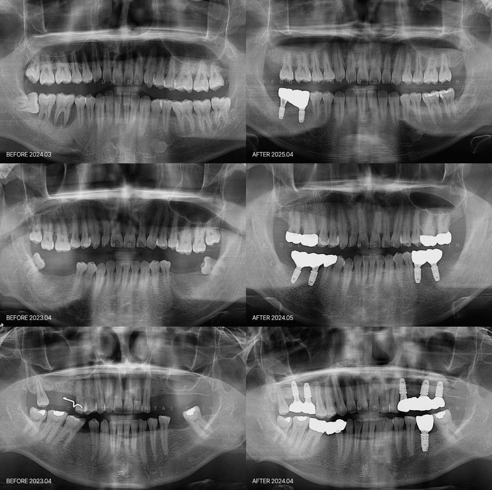 어금니 임플란트 앞니보다 신중해야 한다? 숨은 진실 관련 이미지 6