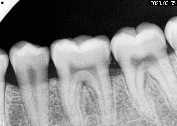 비발치로 돌출입 해소한 증례 관련 이미지 4